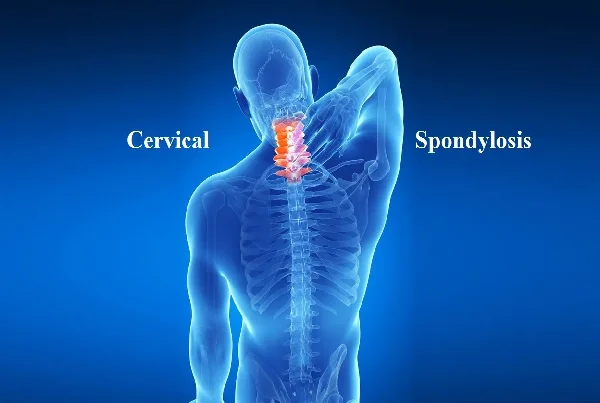 Cervical Spondylosis