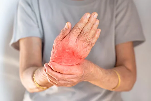 Rheumatoid Arthritis