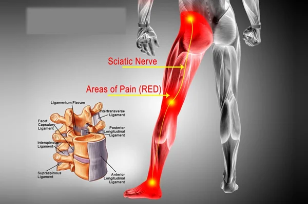Sciatica Pain