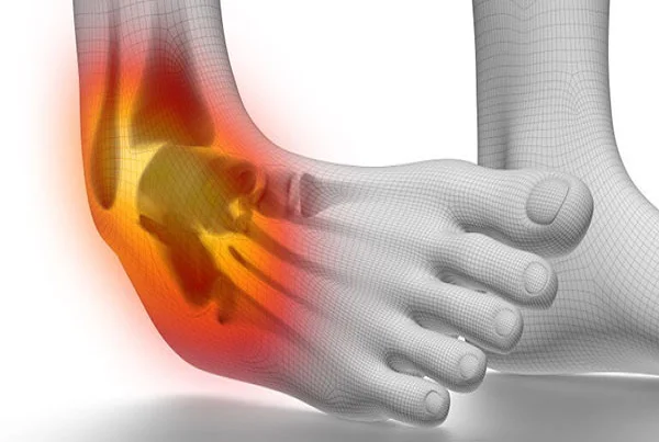 Ligament Tears