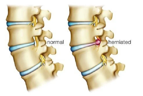 Disc Prolapse