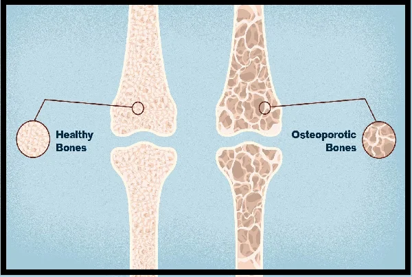 Osteoporosis Management