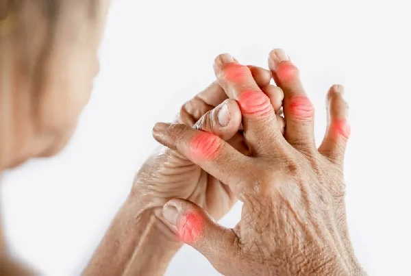 Arthritis Management for Older Adults